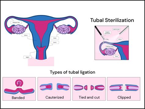 Tubal ligation